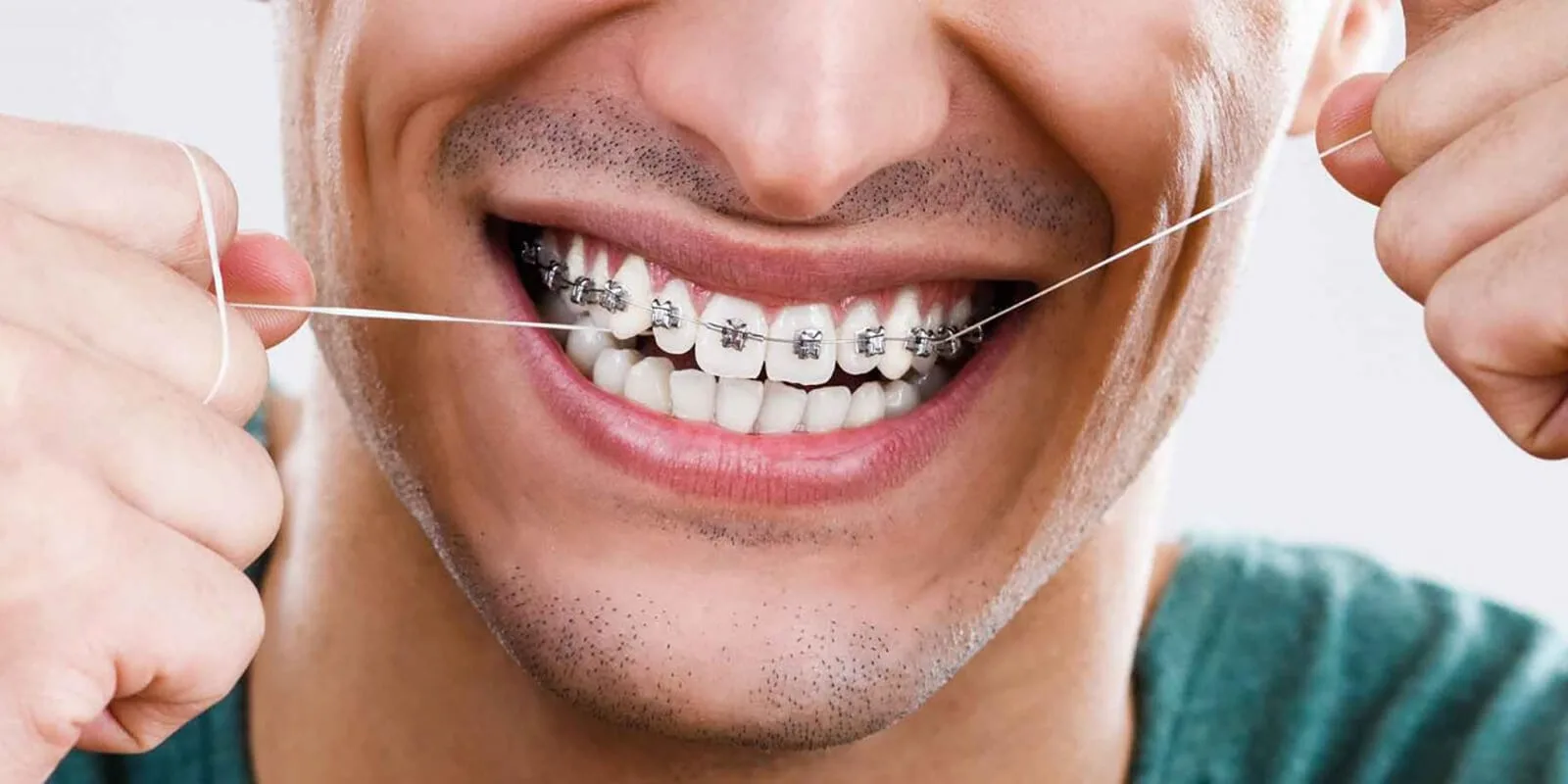 Common Misconceptions About Orthodontic (Braces) Treatment
