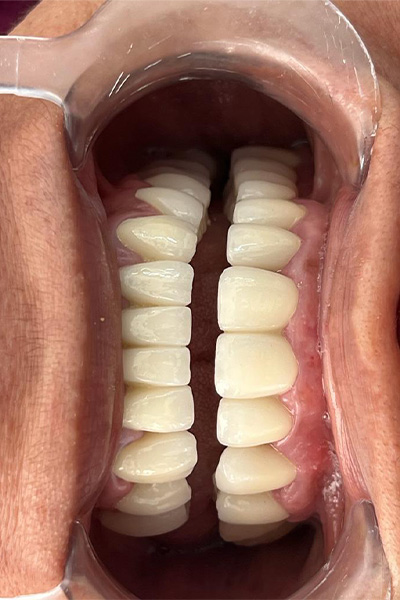 Teeth Whitening after