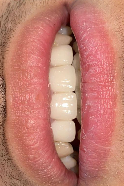 Orthodontic Treatment after