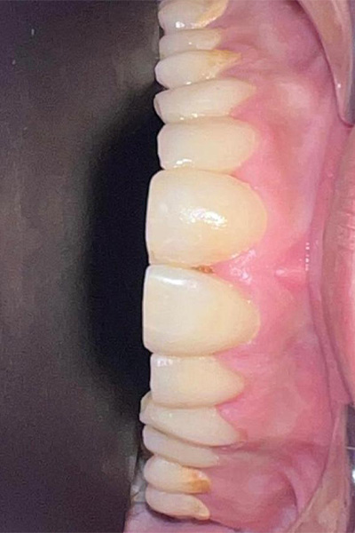 Porcelain Veneers after