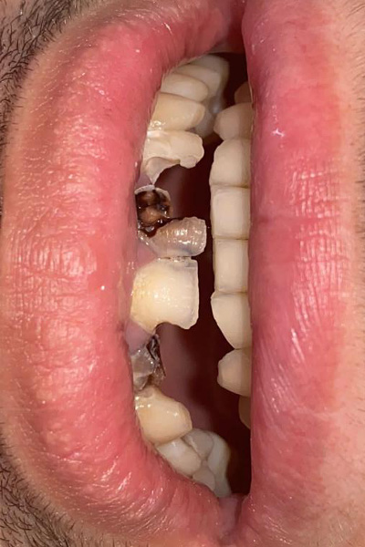 Orthodontic Treatment before