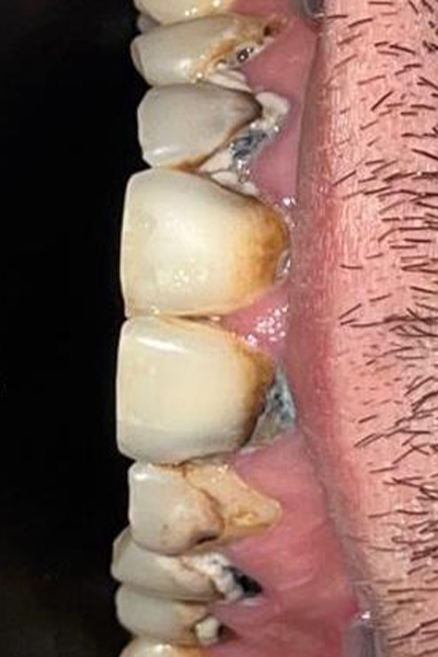 Porcelain Veneers before