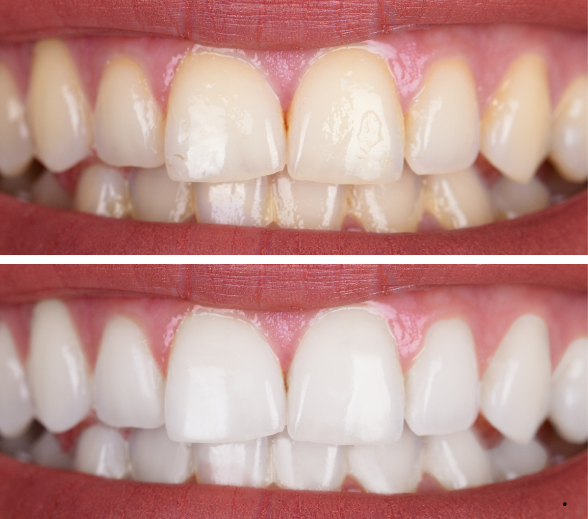 Before and after image of professional teeth whitening