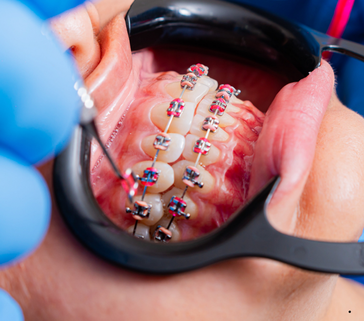 Fixed orthodontic braces attached to upper and lower teeth