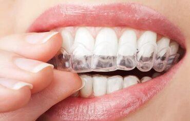 Clear custom dental night guard being placed over the teeth