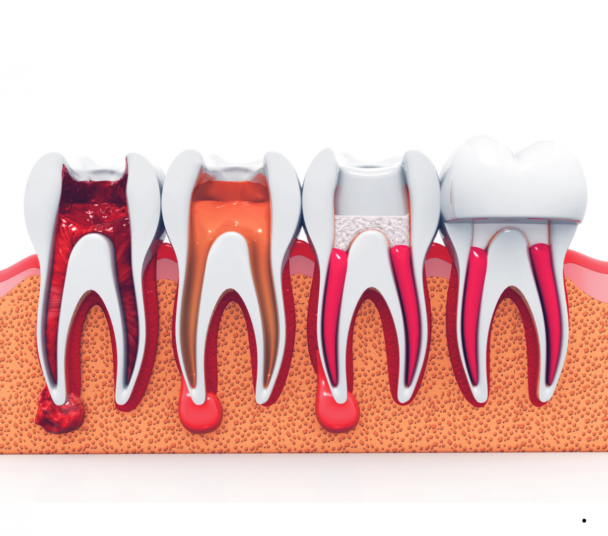 Illustration of stages of root canal treatment
