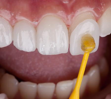 Application of a thin ceramic laminate veneer to a front tooth